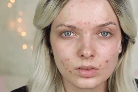 Home Remedies For Acne Guide